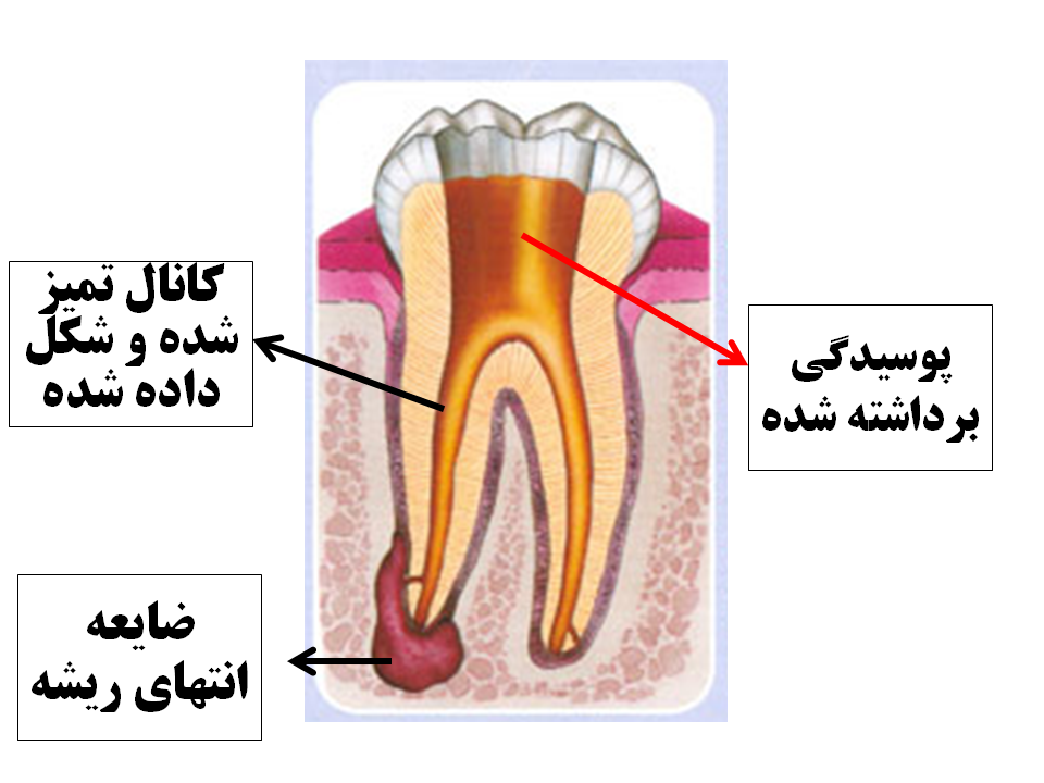 عصب کشی بدون درد چگونه انجام می گردد