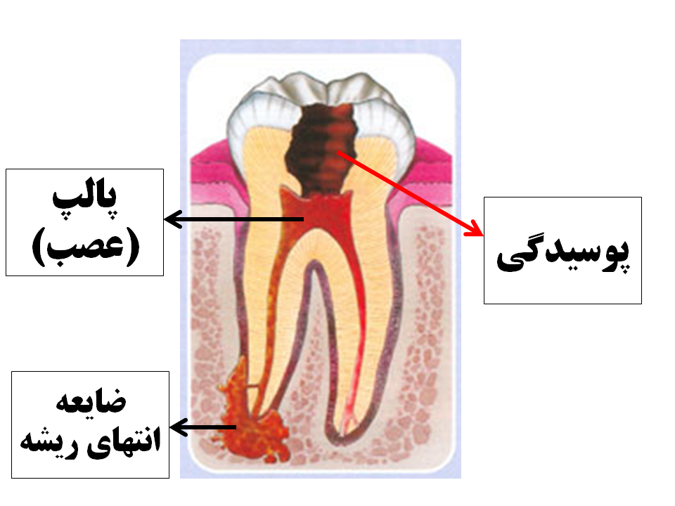 عصب کشی بدون درد چیست