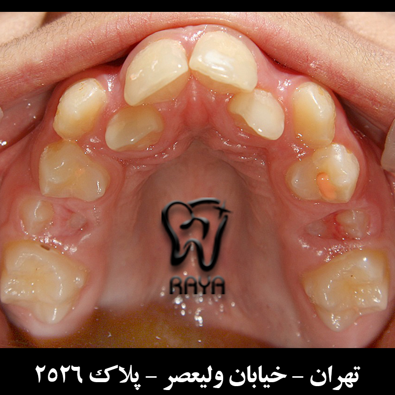 دندانهای نامرتب
