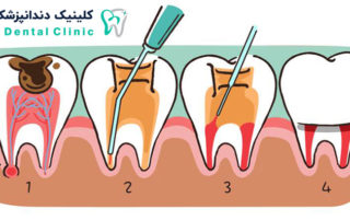 عصب کشی دندان