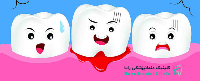 Bleeding-Implant-Gums-Teeth-RAYADENTALCLINIC