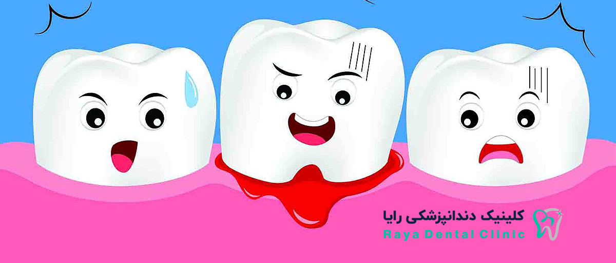 Bleeding-Implant-Gums-Teeth-RAYADENTALCLINIC