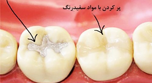پركردن دندان با مواد مخصوص
