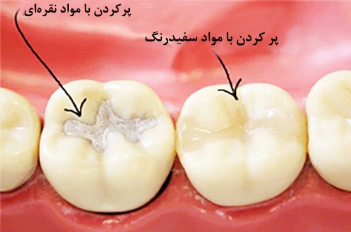 پرکردن دندان با مواد مخصوص