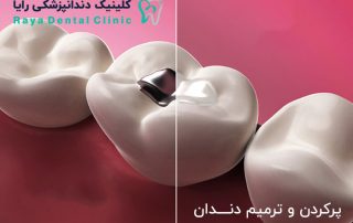 پركردن دندان-Dental Fillings