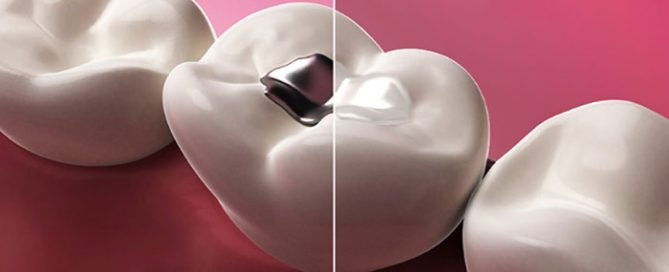پركردن دندان-Dental Fillings