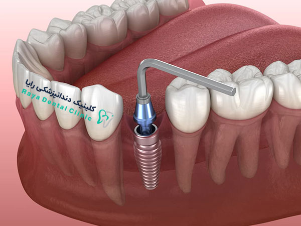 روش جدید کاشت دندان آسیاب با ایمپلنت