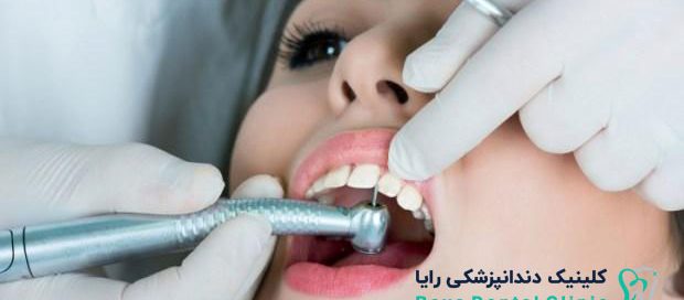 پركردن دندان جلو