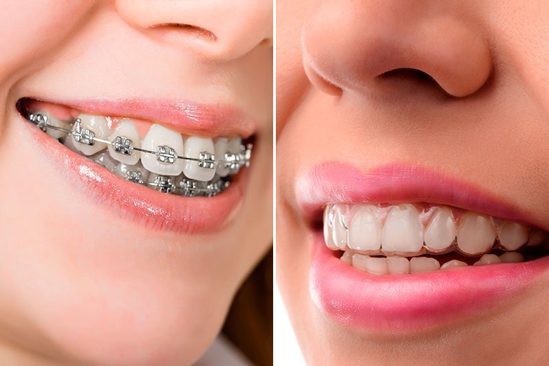 روش های زیبایی دندان