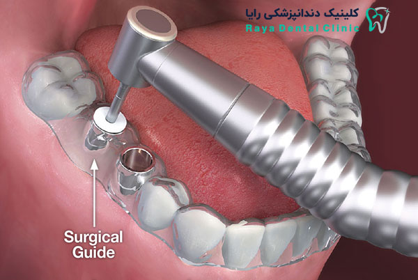 جدیدترین تکنولوژی کاشت دندان