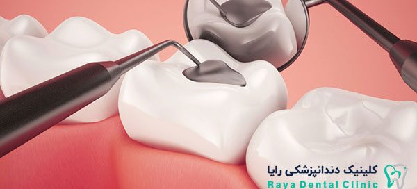 پر کردن دندان