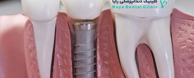Dentalimplants-کاشت دندان