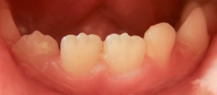 ماملون دندان کودکان