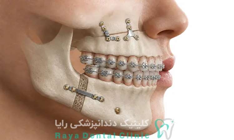 جراحی فک