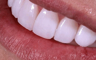 لمینت دندان