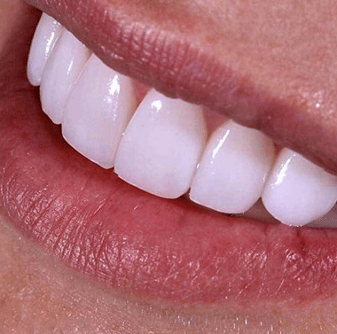 لمینت دندان