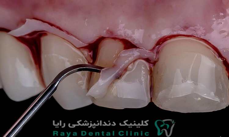 جراحی لثه