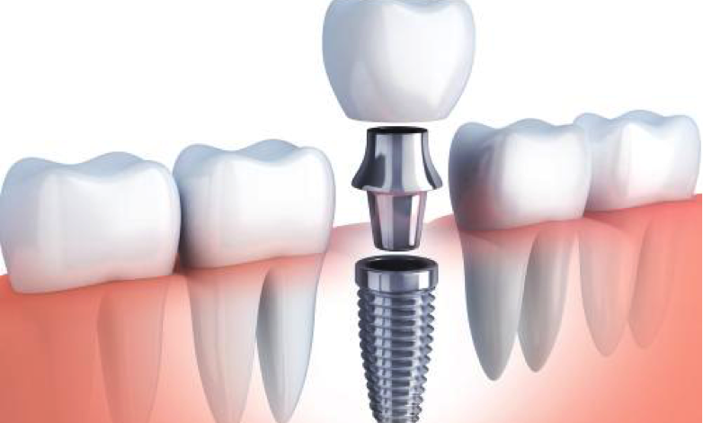 بهترین نوع ایمپلنت