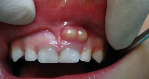عفونت و آبسه دندان کودکان