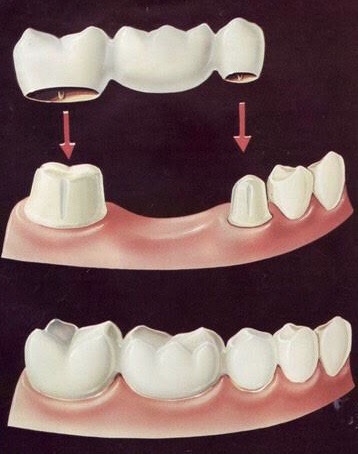 انواع بریج دندان