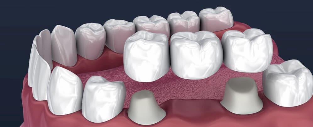 بهترین برند بریج دندان