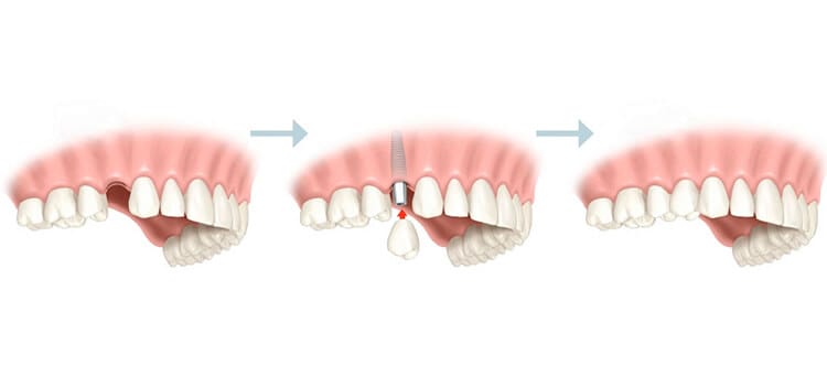 کاشت دندان بدون ایمپلنت