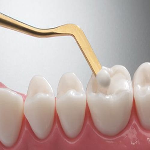 مراقبت از کامپوزیت های دندان