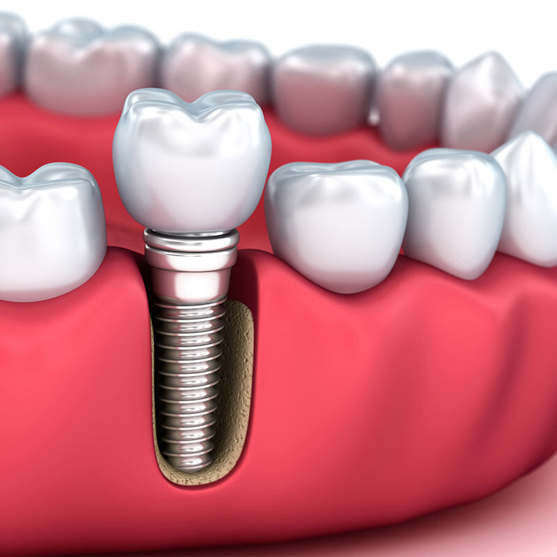 کاشت دندان به روش ایمپلنت