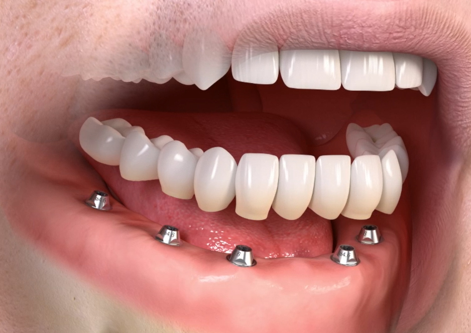 ایمپلنت کامل دندان ها