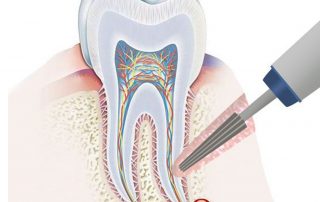 درمان عفونت دندان