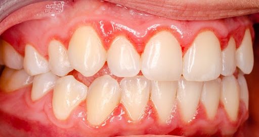 ورم لثه ناشی از چیست؟