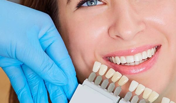 انتخاب رنگ لمینت دندان