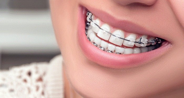درمان دندان با ارتودنسی