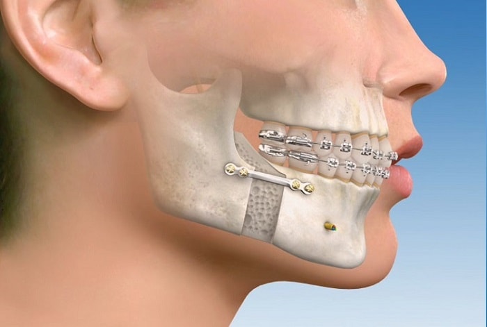 درمان حرکت دندان ها