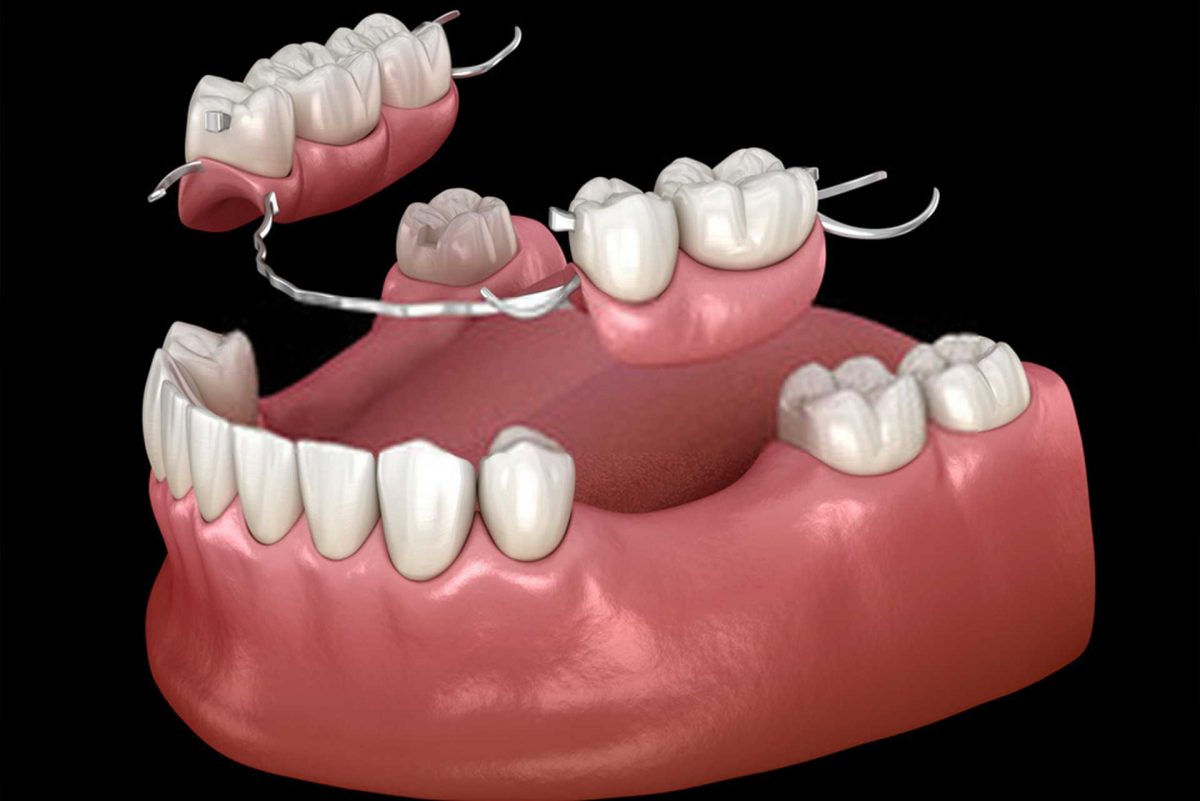 اوردنچر ثابت چیست؟