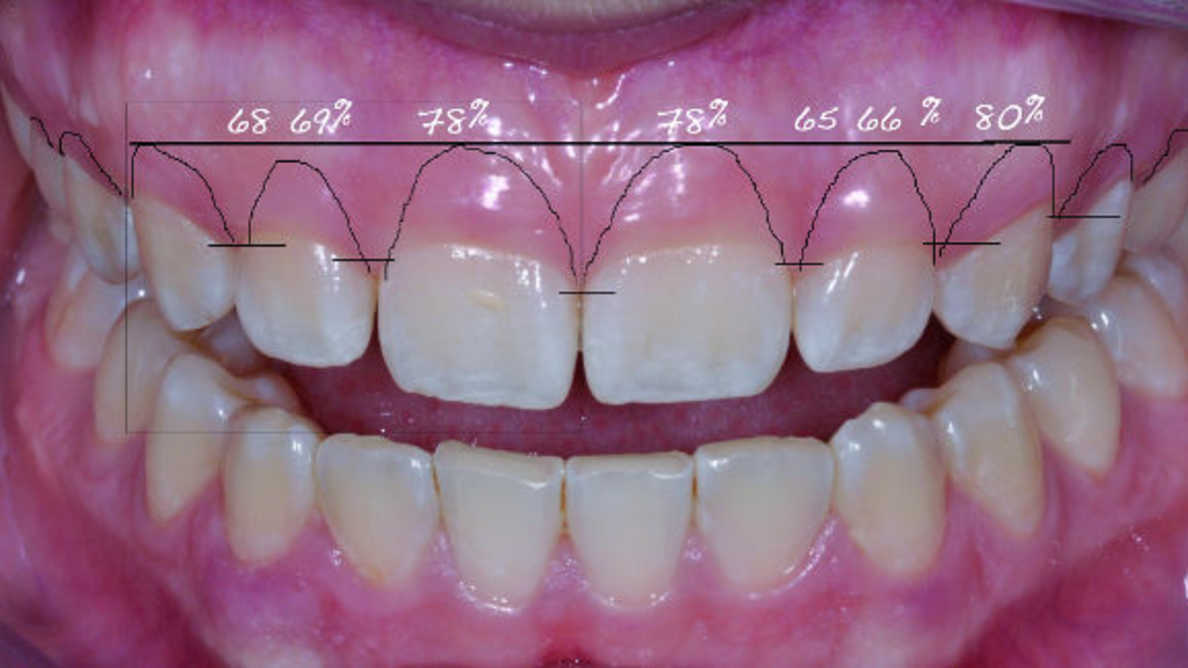 عمل زیبایی دندان