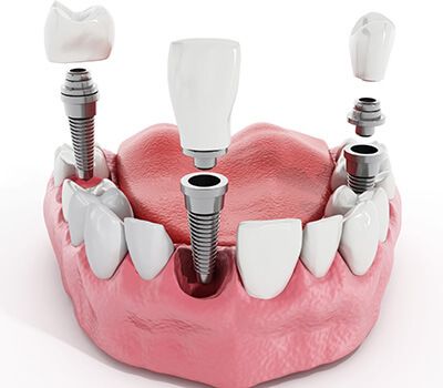 مراحل کاشت دندان