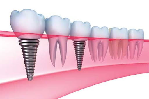 ایمپلنت دندان چیست؟
