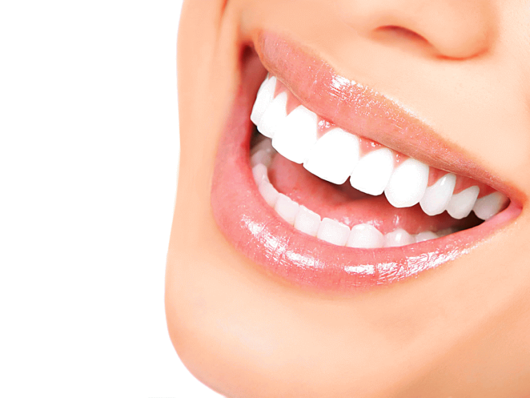 لمینت دندان چیست؟