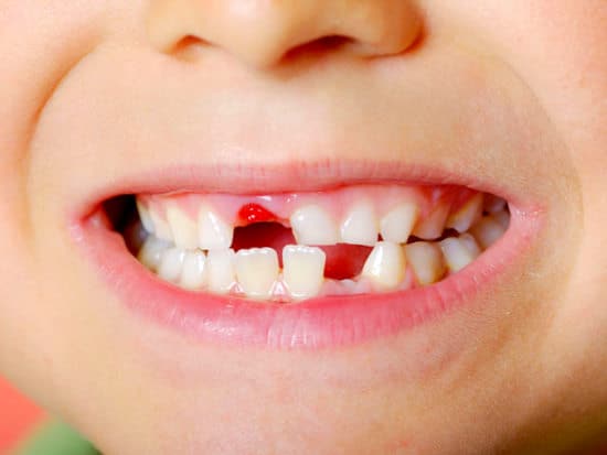 دندان های شیری