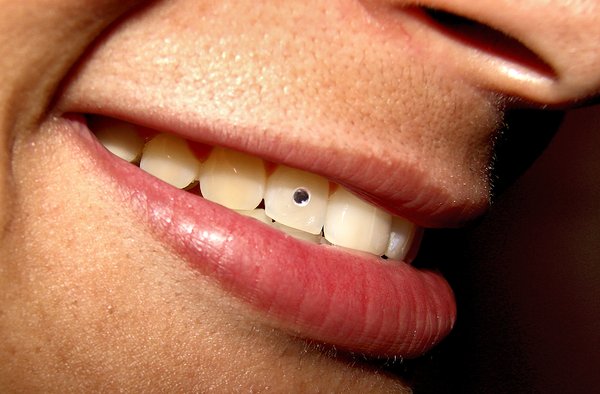 مضرات پیرسینگ دندان