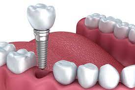 مهم ترین مزایای ایمپلنت دندان