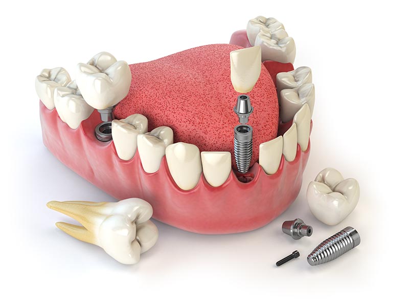 روش کاشت دندان