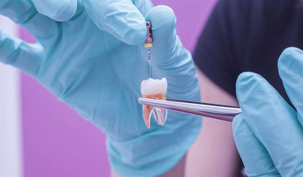 درمان کانال ریشه دندان