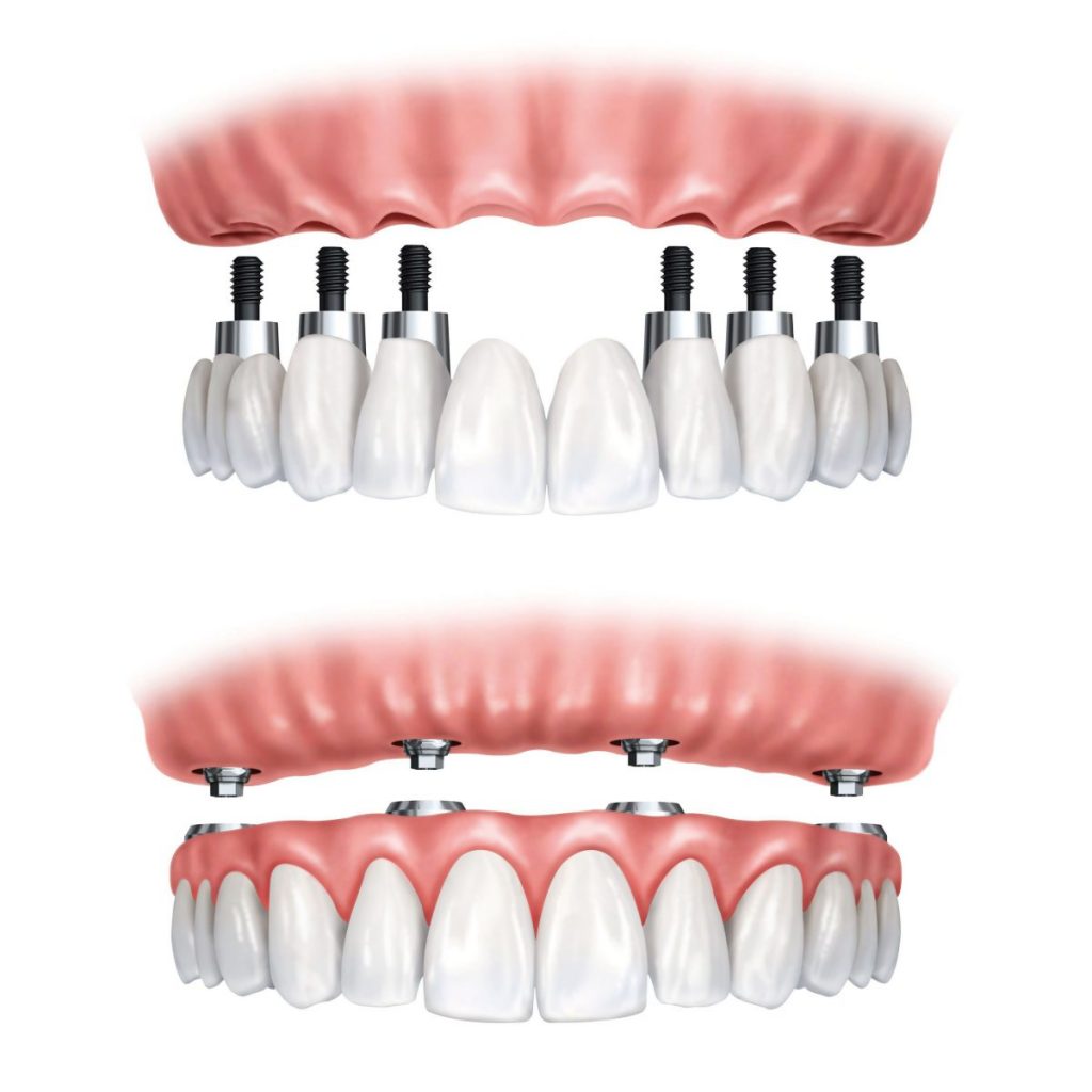 روش های مختلف کاشت دندان