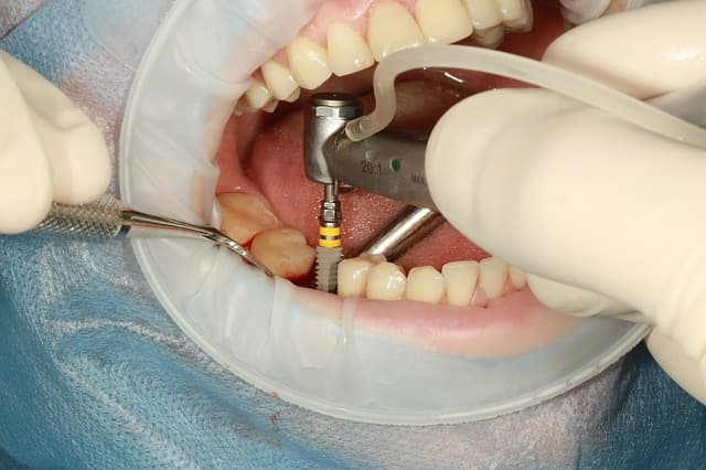 ایمپلنت دندان بدون جراحی و خونریزی