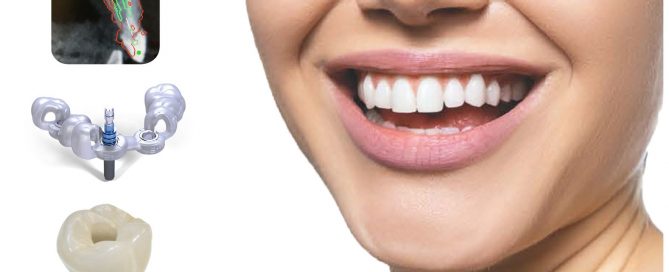 مزایای کاشت ایمپلنت