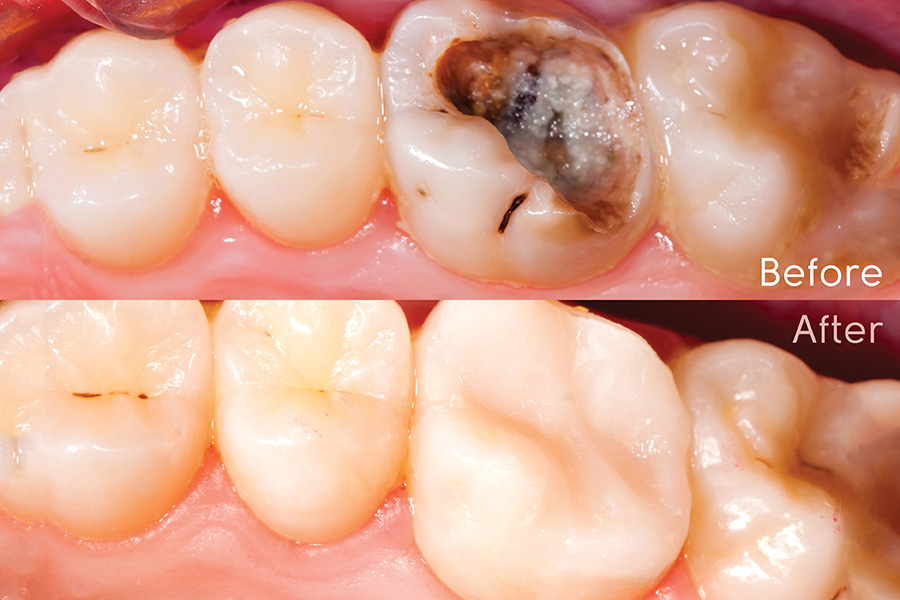 مزایای کامپوزیت دندان برای ترمیم دندان