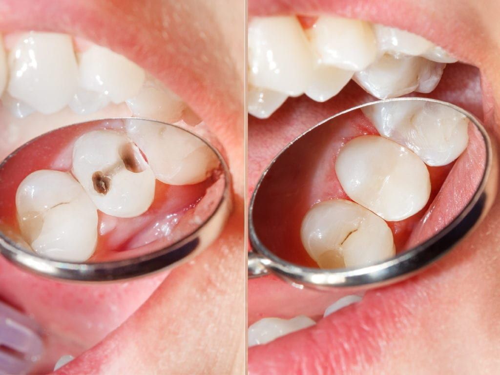 مزایای کامپوزیت دندان