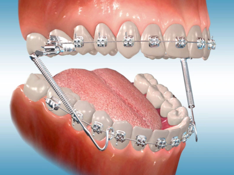 اصلاح دندان ها با ارتودنسی